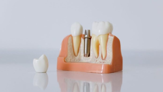 ce-diferenta-face-brandul-unui-implant-dentar